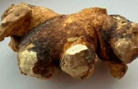 В Симферополе выставили на продажу почечный кам...